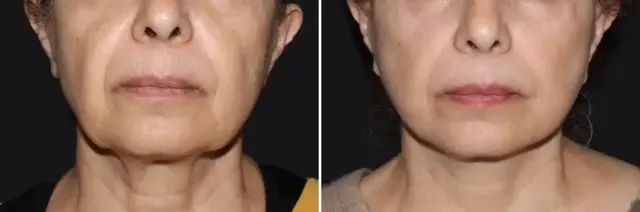 Facelift result at SoCal Aesthetic Surgery in Irvine, CA
