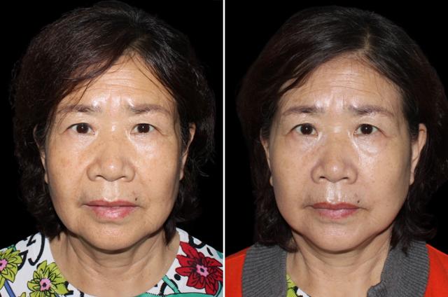 Facelift result at SoCal Aesthetic Surgery in Irvine, CA