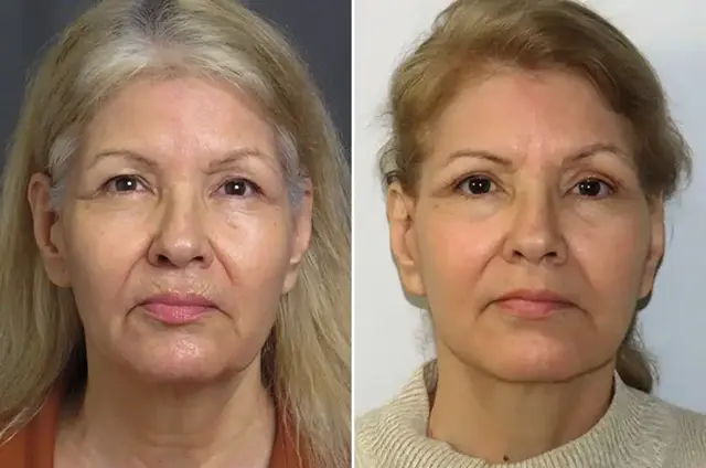 Blepharoplasty result at SoCal Aesthetic Surgery in Irvine, CA
