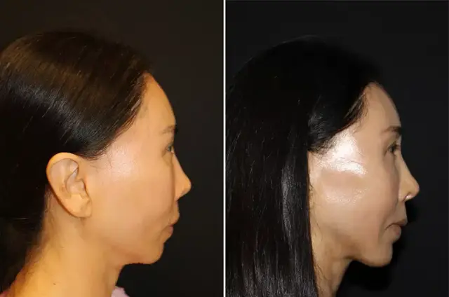 Chin Implant result at SoCal Aesthetic Surgery in Irvine, CA