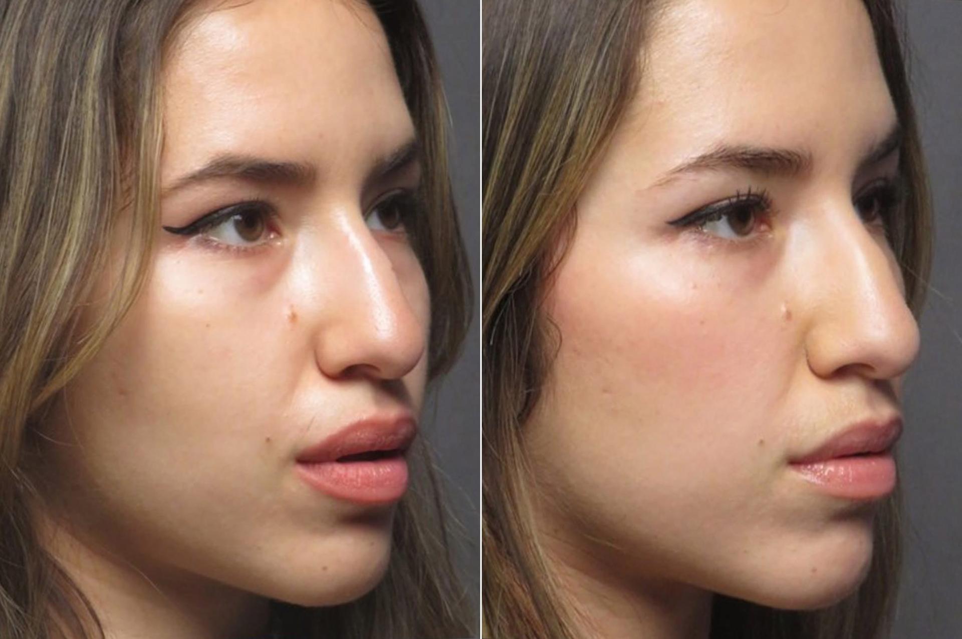 SoCal Aesthetic Surgery undereye filler result — Irvine, CA