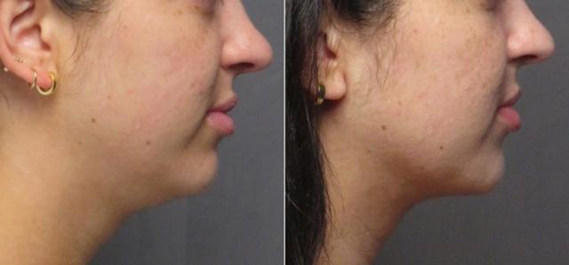 Neck Liposuction result at SoCal Aesthetic Surgery in Irvine, CA
