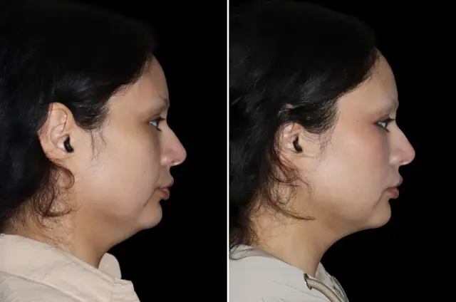 Neck Liposuction result at SoCal Aesthetic Surgery in Irvine, CA