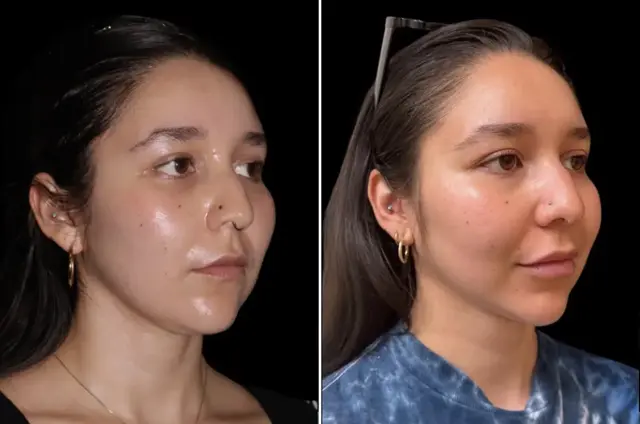 Neck Liposuction result at SoCal Aesthetic Surgery in Irvine, CA
