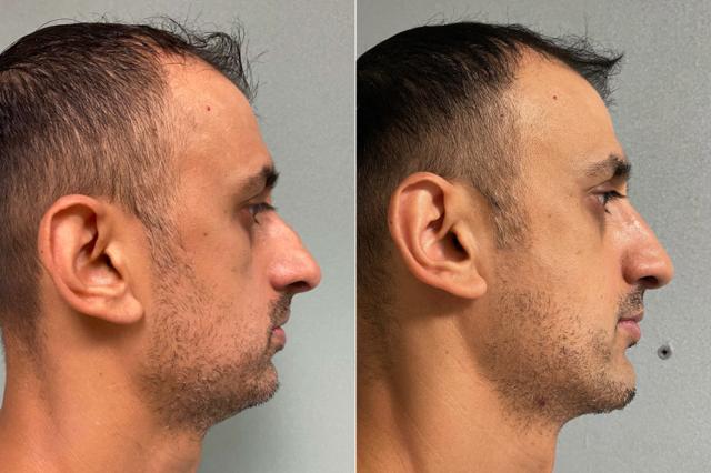 Chin Implant result at SoCal Aesthetic Surgery in Irvine, CA