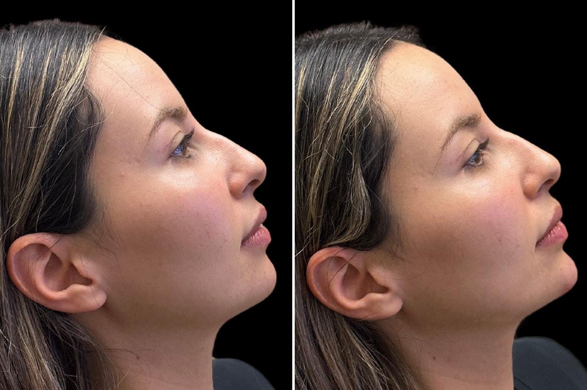 SoCal Aesthetic Surgery jawline filler result — Irvine, CA
