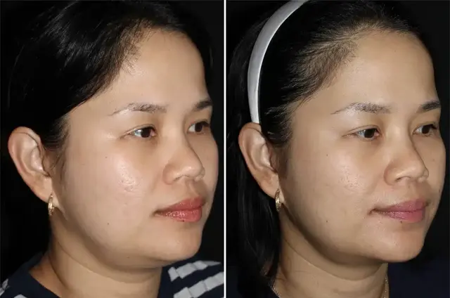 Neck Liposuction result at SoCal Aesthetic Surgery in Irvine, CA