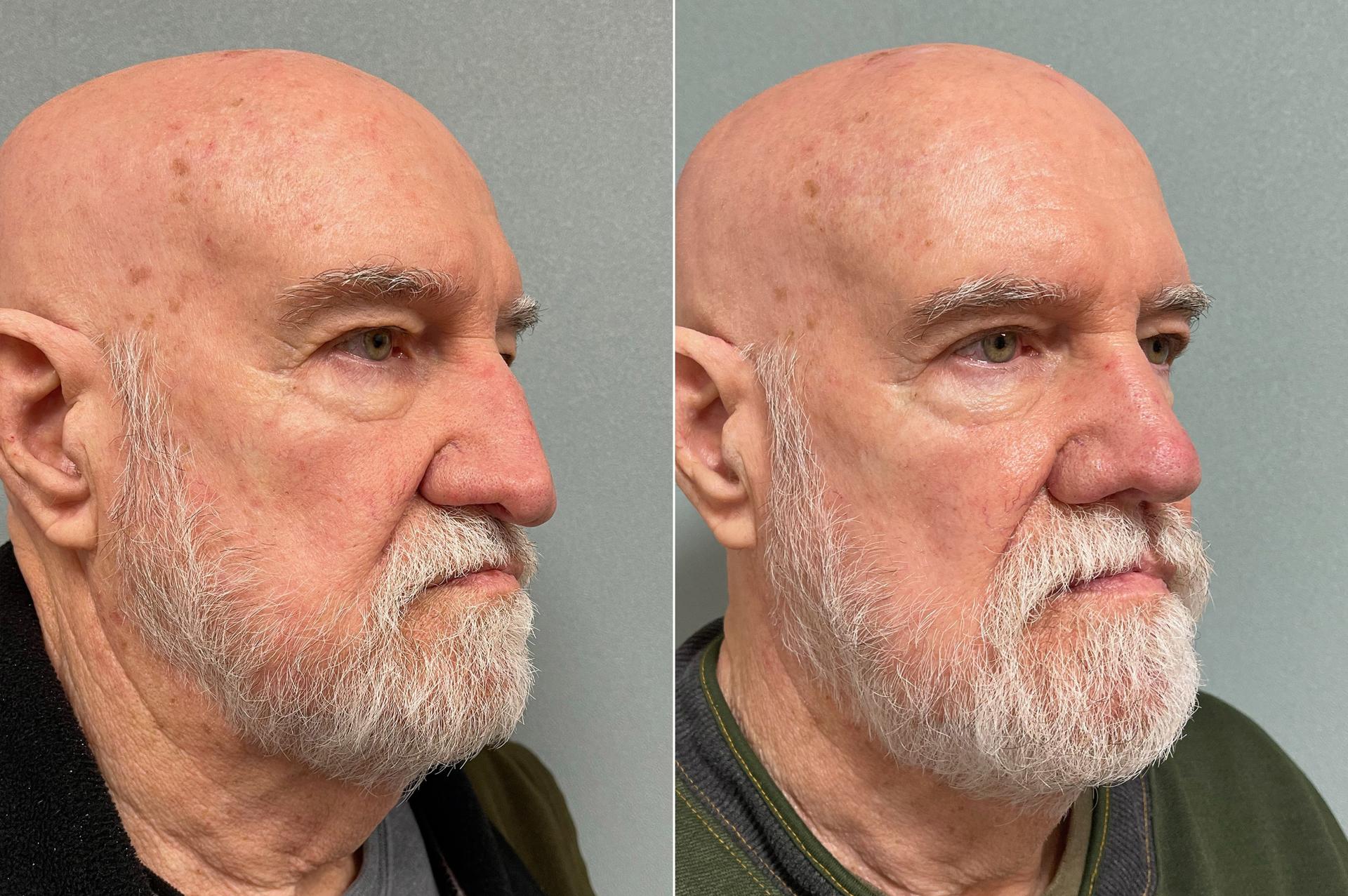 SoCal Aesthetic Surgery rhinoplasty result — Irvine, CA