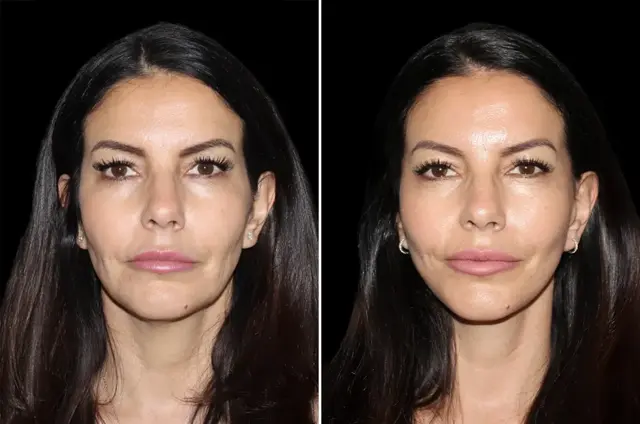 Facelift result at SoCal Aesthetic Surgery in Irvine, CA