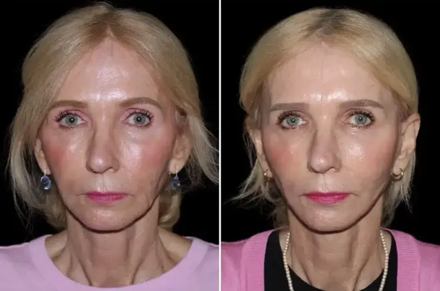 Facelift result at SoCal Aesthetic Surgery in Irvine, CA