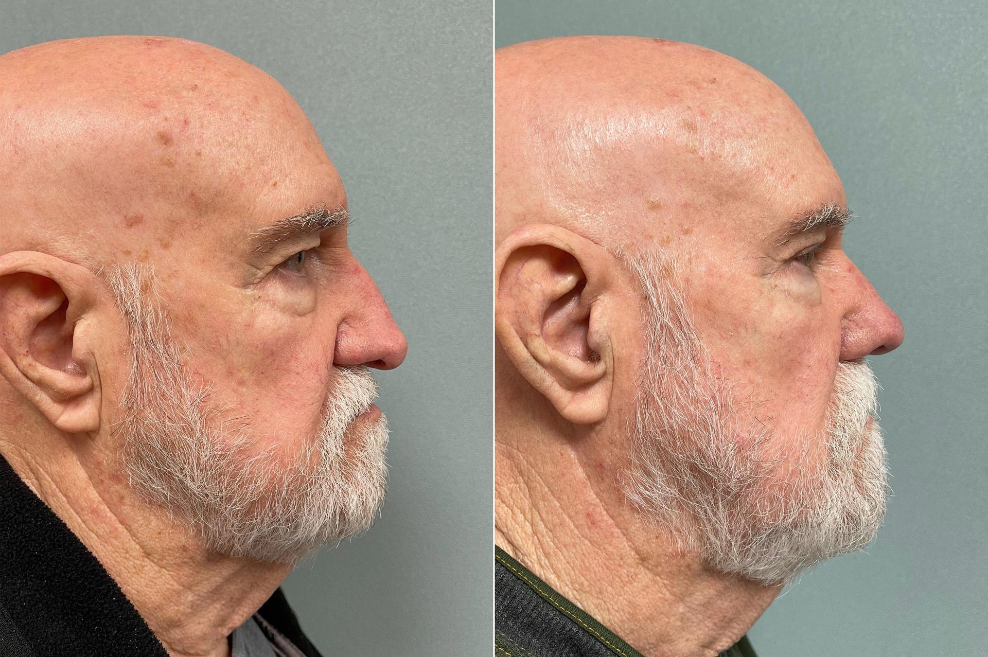 SoCal Aesthetic Surgery rhinoplasty result — Irvine, CA