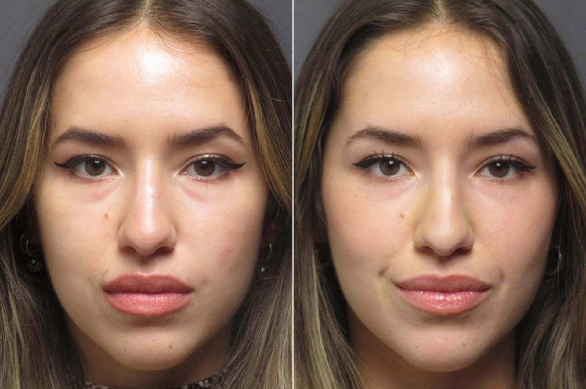 SoCal Aesthetic Surgery undereye filler result — Irvine, CA