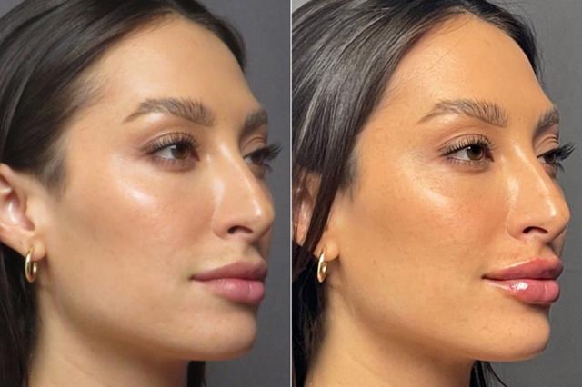 Lip Filler result at SoCal Aesthetic Surgery in Irvine, CA