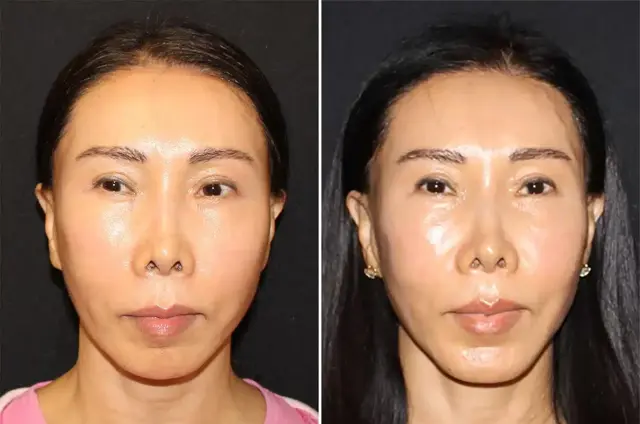 Chin Implant result at SoCal Aesthetic Surgery in Irvine, CA