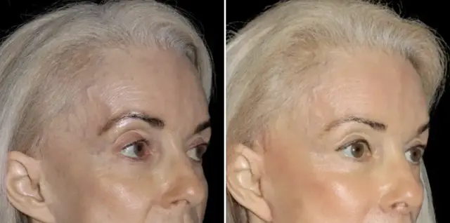 Fat Transfer result at SoCal Aesthetic Surgery in Irvine, CA