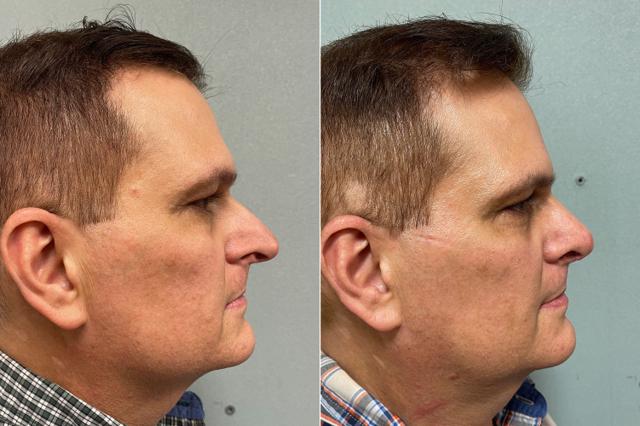 Rhinoplasty result at SoCal Aesthetic Surgery in Irvine, CA