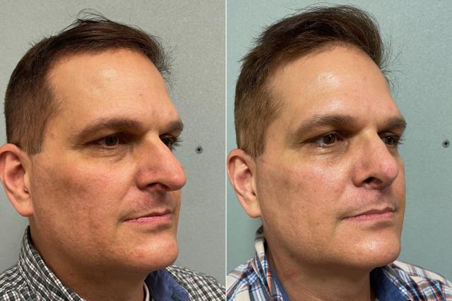 Rhinoplasty result at SoCal Aesthetic Surgery in Irvine, CA