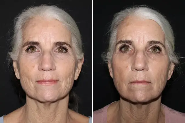Botox result at SoCal Aesthetic Surgery in Irvine, CA