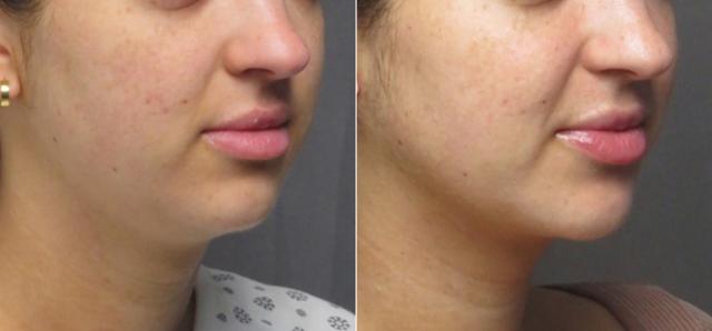 Neck Liposuction result at SoCal Aesthetic Surgery in Irvine, CA