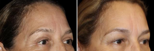 Blepharoplasty result at SoCal Aesthetic Surgery in Irvine, CA
