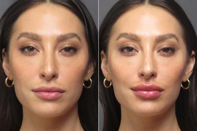 Lip Filler result at SoCal Aesthetic Surgery in Irvine, CA