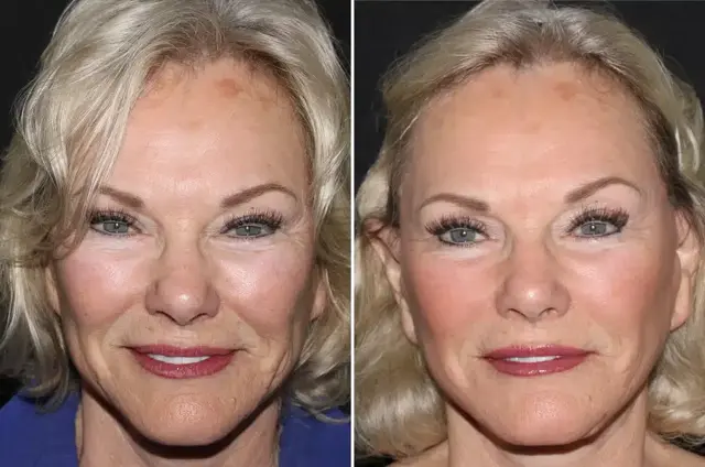 Facelift result at SoCal Aesthetic Surgery in Irvine, CA