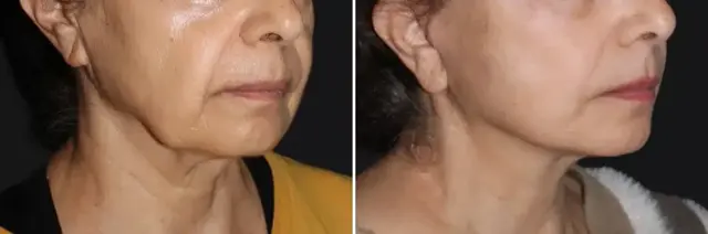 Facelift result at SoCal Aesthetic Surgery in Irvine, CA