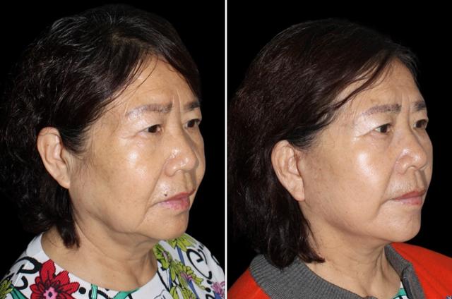 Facelift result at SoCal Aesthetic Surgery in Irvine, CA