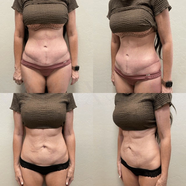 Phoenix Plastic Surgery tummy tuck result — Phoenix, AZ