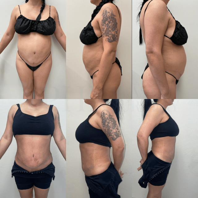 Phoenix Plastic Surgery tummy tuck result — Phoenix, AZ
