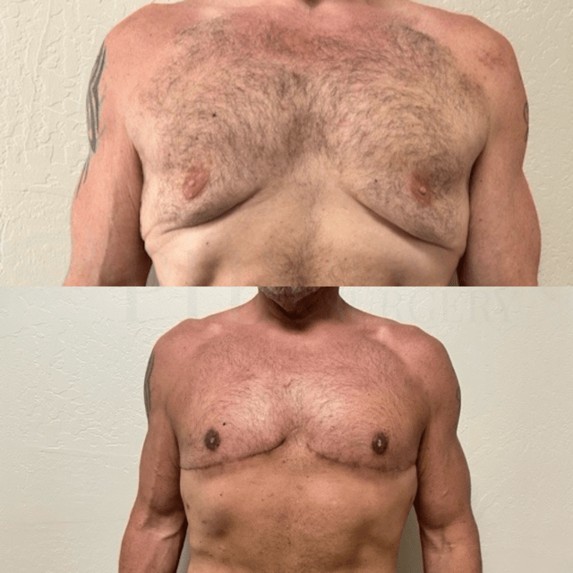 Gynecomastia Surgery result at Phoenix Plastic Surgery in Phoenix, AZ