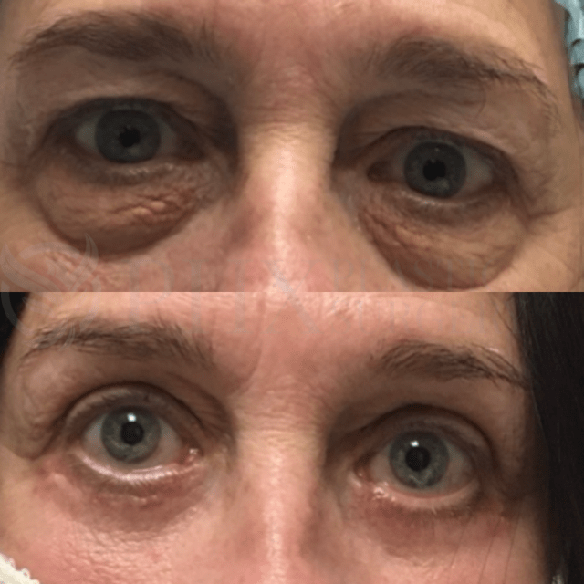 Blepharoplasty result at Phoenix Plastic Surgery in Phoenix, AZ