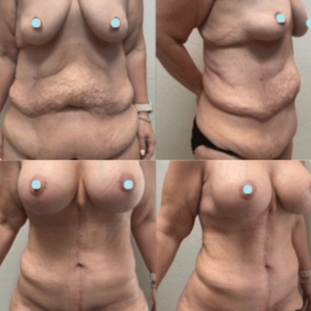 Phoenix Plastic Surgery tummy tuck result — Phoenix, AZ