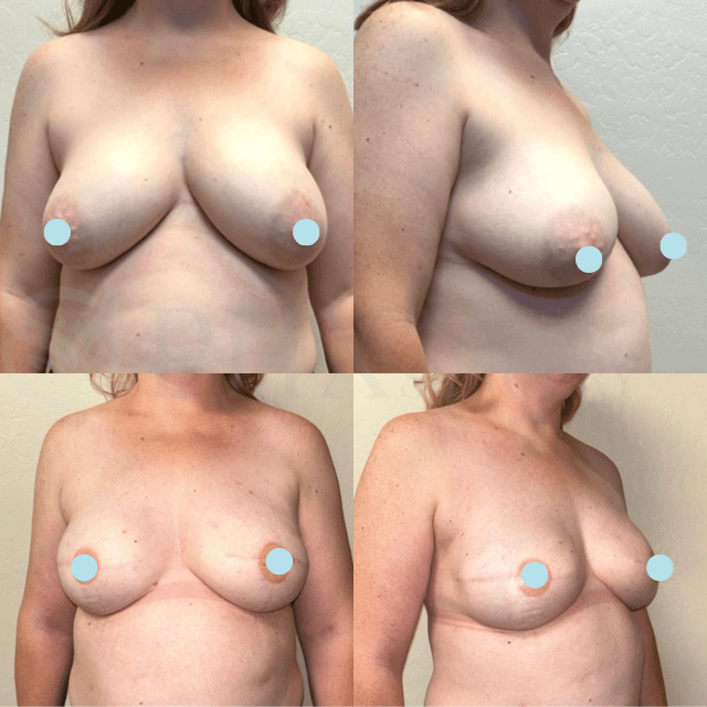 Breast Reduction result at Phoenix Plastic Surgery in Phoenix, AZ