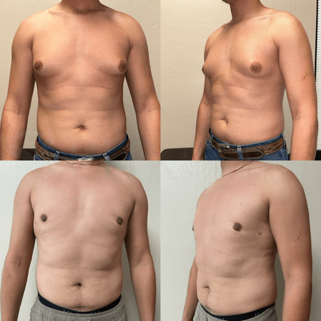 Gynecomastia Surgery result at Phoenix Plastic Surgery in Phoenix, AZ