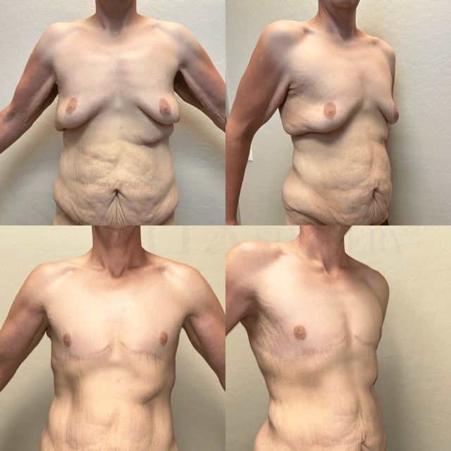 Phoenix Plastic Surgery tummy tuck result — Phoenix, AZ