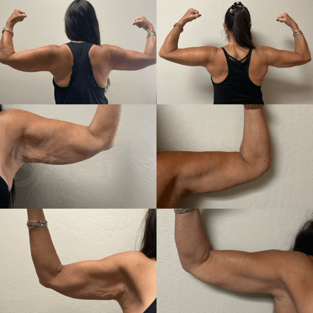 Phoenix Plastic Surgery tummy tuck result — Phoenix, AZ