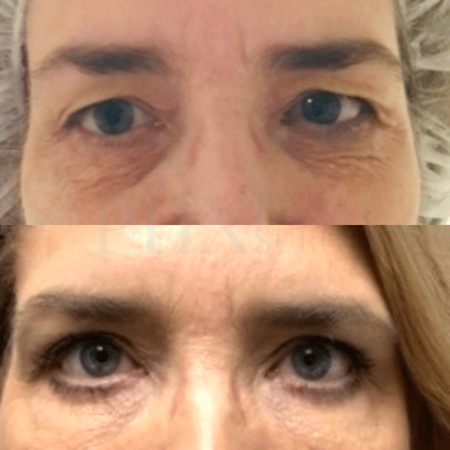 Blepharoplasty result at Phoenix Plastic Surgery in Phoenix, AZ
