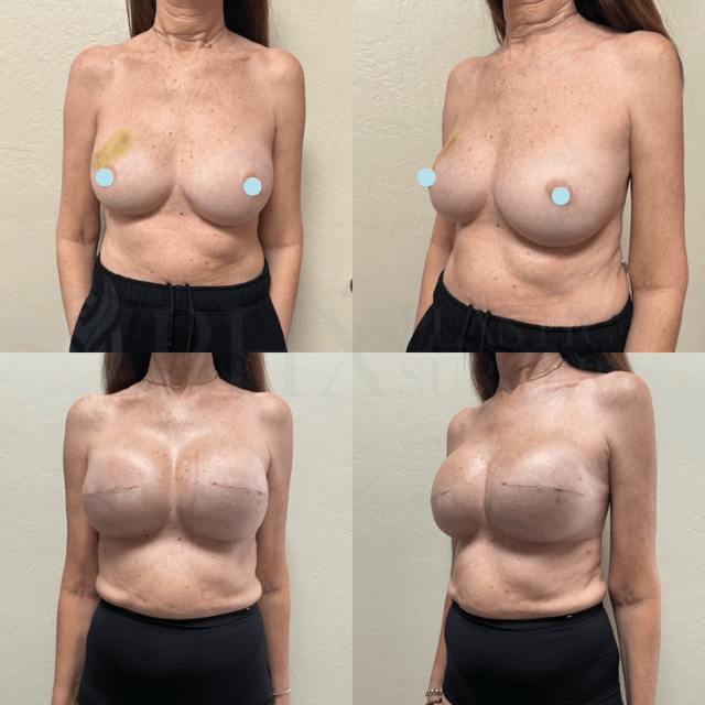 Breast Augmentation result at Phoenix Plastic Surgery in Phoenix, AZ