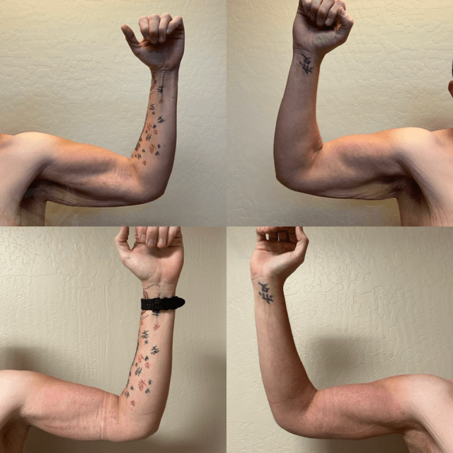 Phoenix Plastic Surgery tummy tuck result — Phoenix, AZ
