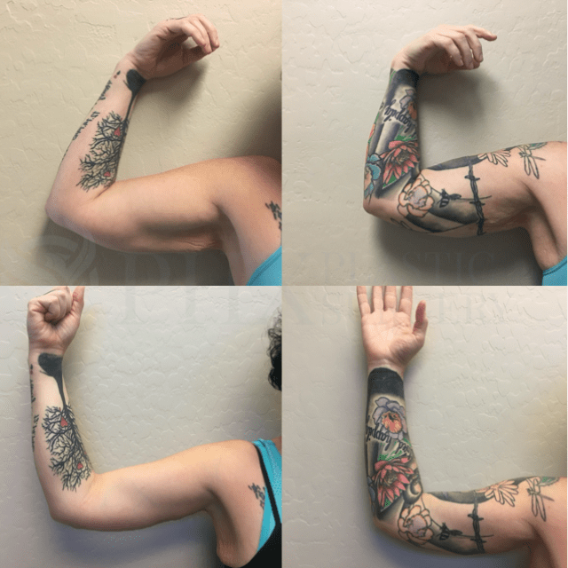 Phoenix Plastic Surgery tummy tuck result — Phoenix, AZ