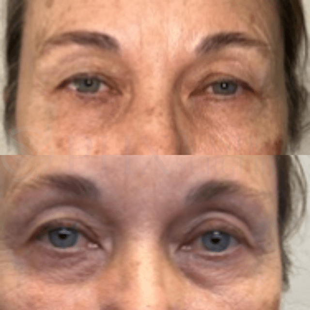 Blepharoplasty result at Phoenix Plastic Surgery in Phoenix, AZ