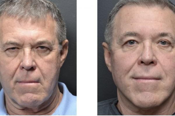 Utah Eyelid & Facial Plastic Surgery facelift result — Millcreek, UT