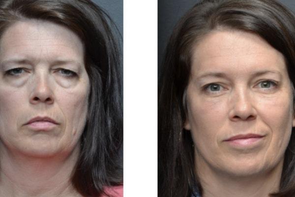 Utah Eyelid & Facial Plastic Surgery eyelid lift result — Millcreek, UT