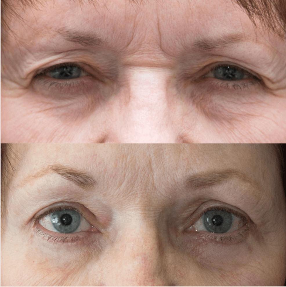 Utah Eyelid & Facial Plastic Surgery eyelid lift result — Millcreek, UT