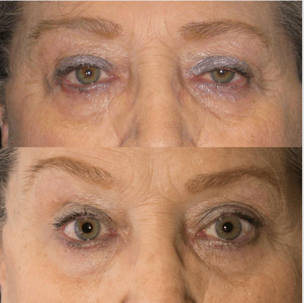 Utah Eyelid & Facial Plastic Surgery eyelid lift result — Millcreek, UT