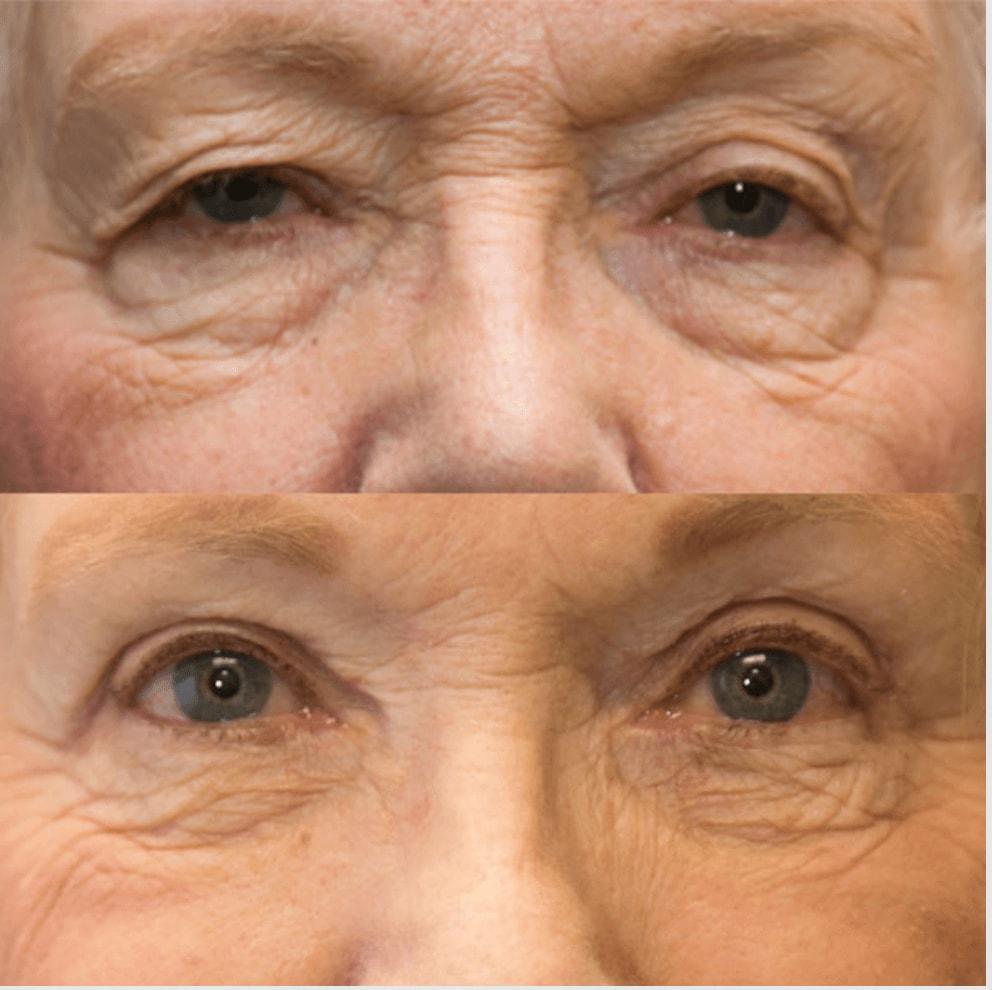 Utah Eyelid & Facial Plastic Surgery eyelid lift result — Millcreek, UT