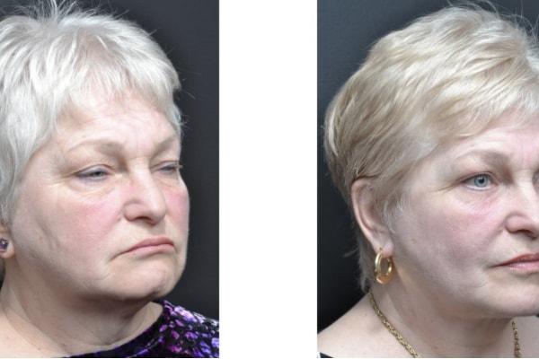 Utah Eyelid & Facial Plastic Surgery facelift result — Millcreek, UT
