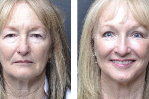 Deep Plane Facelift result at Utah Eyelid & Facial Plastic Surgery in Millcreek, UT