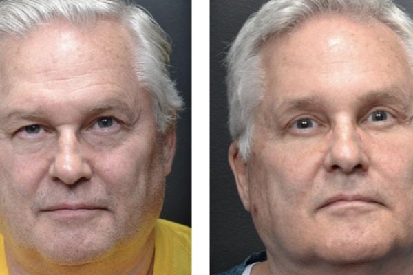 Utah Eyelid & Facial Plastic Surgery facelift result — Millcreek, UT